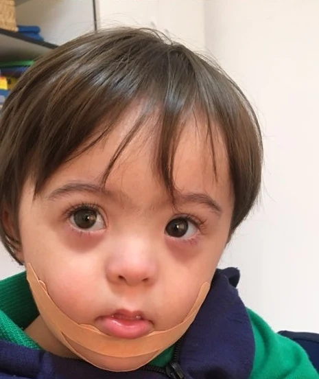 Menino com Trissomia 21 com bandagem elástica aplicada no queixo e na região dos lábios
