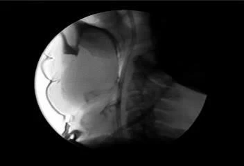 Videofluoroscopia com estase em cavidade oral e contraste extraoral