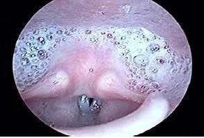 Nasoendoscopia mostrando estase salivar